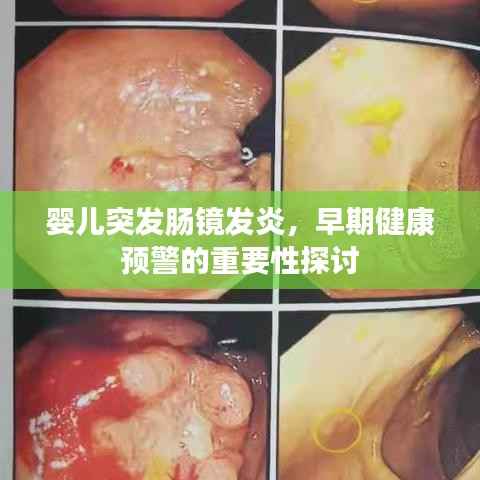 婴儿突发肠镜发炎,早期健康预警的重要性探讨