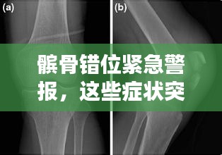 髌骨错位紧急警报,这些症状突发,你需要知道!